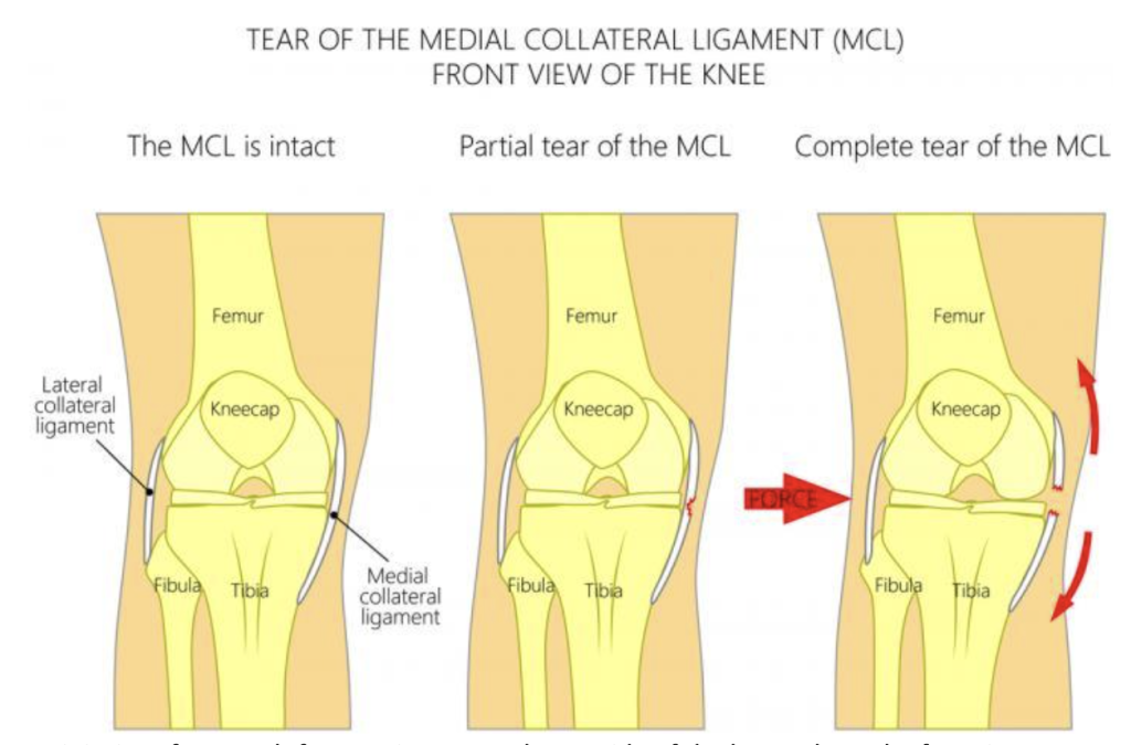 Medial Collateral Ligament (MCL) Injury - Mundaring & Hills Physiotherapy